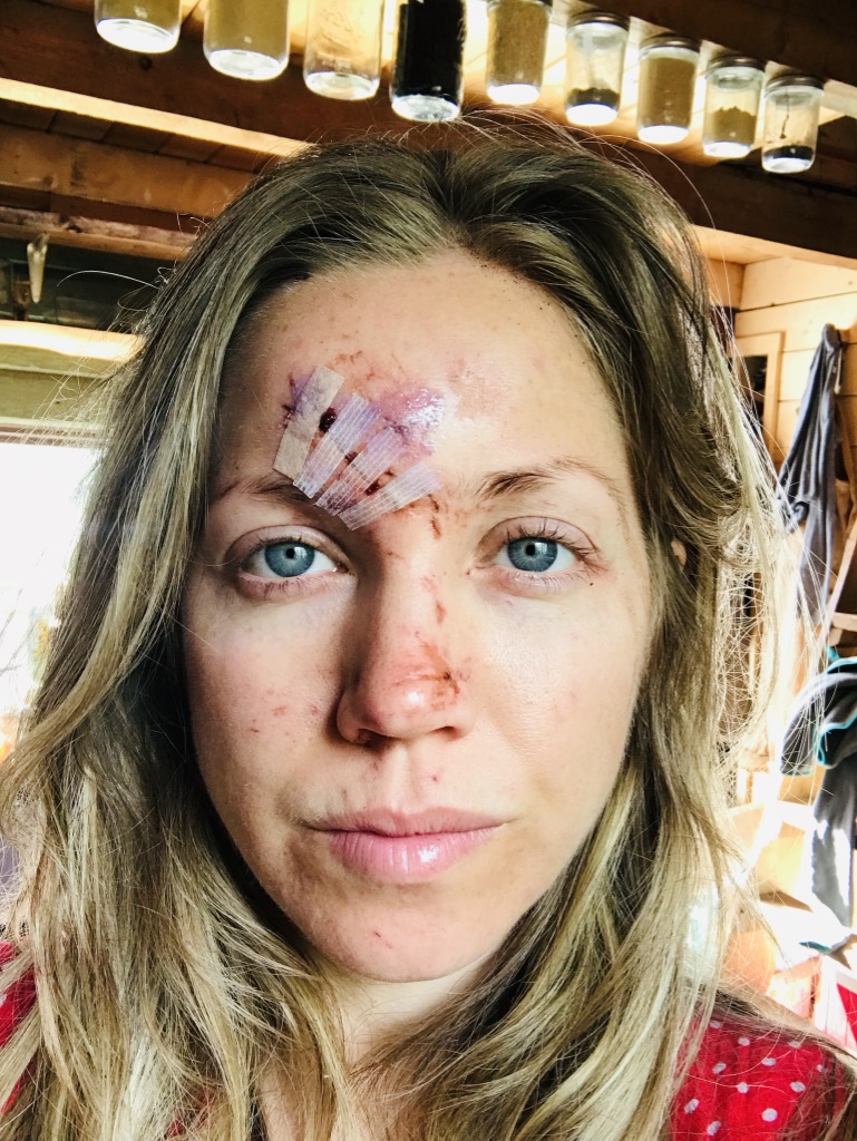 Beneath the Borealis 07-22-19 Everything Changes (Even Your Face) Facial scarring